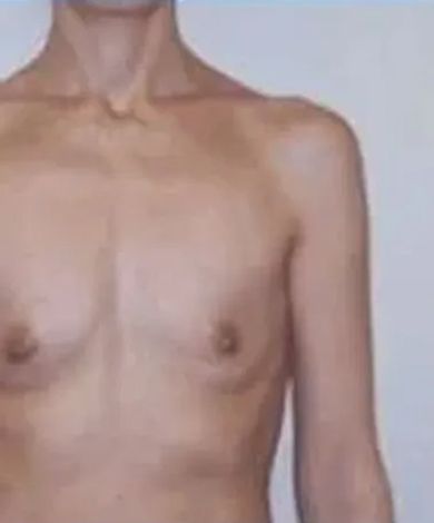 Torso of a person with a pale complexion; collarbone and upper chest visible.