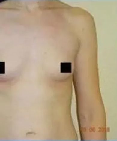 Torso of a person with small breasts, arm extended to the right. The nipples are pixelated.