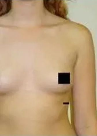 Bare chest of a person, partially obscured by a black square. Beige skin tone.