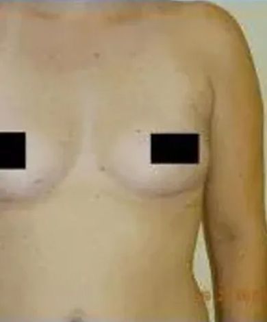 Torso of a person, breasts are partially visible with black boxes covering nipples.