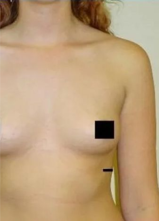 Torso of a person with the right breast partially visible; a black square obscures the nipple area.