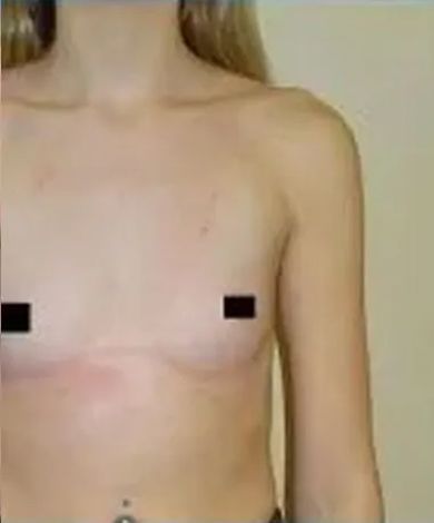 Person's chest after top surgery; scarring and flat chest visible, nipples covered by black squares.