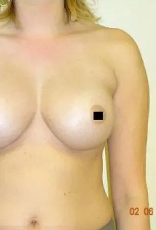 Torso of a person, breasts visible, right nipple pixelated. Light skin, neutral background.