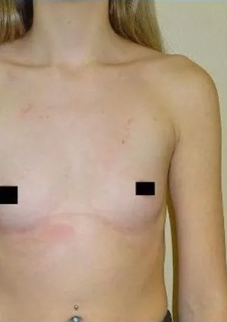 Upper torso of a person with visible scars on chest, nipples obscured by black rectangles.