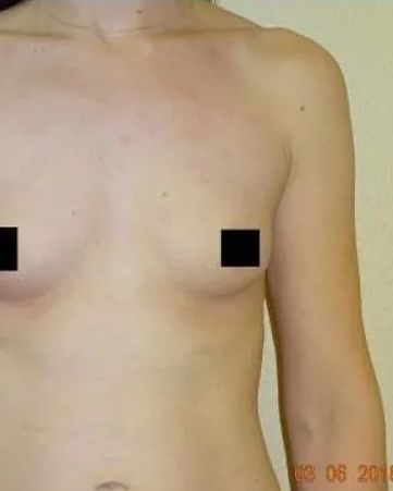 Torso with blacked-out nipples, slightly tanned skin, visible clavicle and right arm.