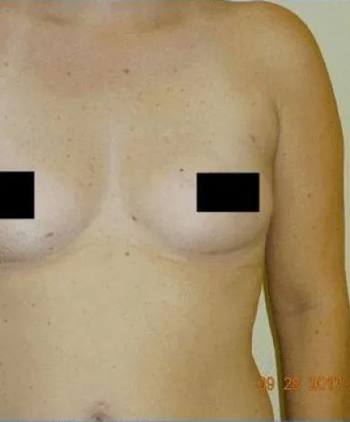 Torso, light skin. Breasts with black rectangles covering nipples. Arms on the right side.
