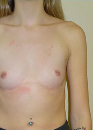 Torso of a person with visible surgical scars and a navel piercing.
