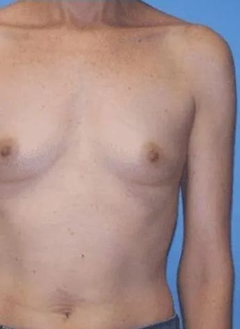 Bare-chested person with light skin, standing against a blue background, showing the chest and arm.