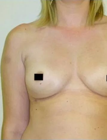 Woman's torso with breasts, nipples obscured. Bruise visible on left arm. Pale skin, neutral background.