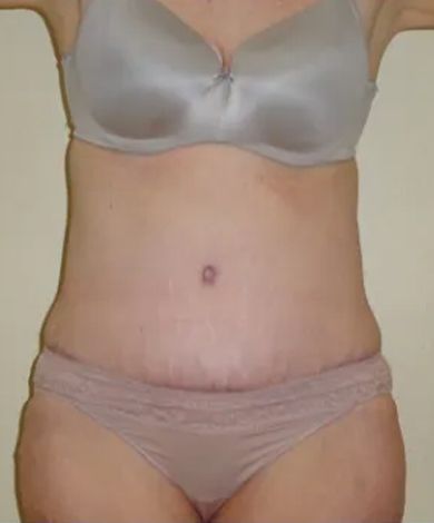 Torso of a person in lingerie; shows abdomen and breasts. A surgical scar is visible.