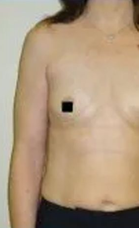Woman's torso with one breast visible. One nipple is covered by a black square. Black waistband, plain background.
