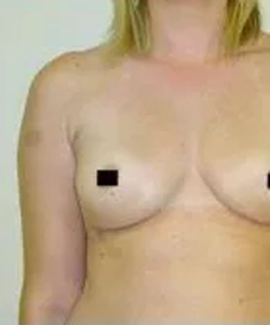 Bare chest of a person, breasts are partially visible, covered by black squares.
