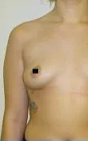 Woman's bare torso, angled view, left breast visible. Nipple obscured. Arm at side, tattoo on side.