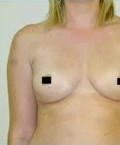 Torso of a person with blonde hair, breasts visible, nipples censored with black squares.