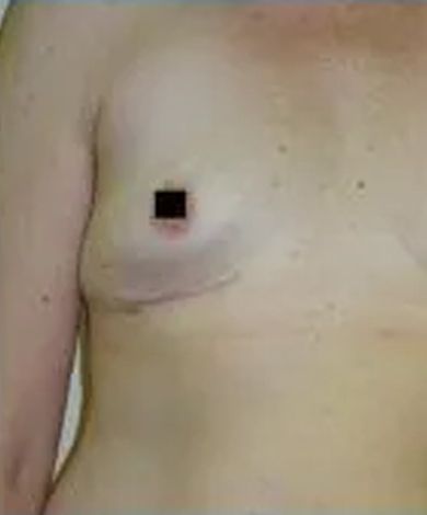Chest with visible scar and darkened area around the nipple, skin-toned.