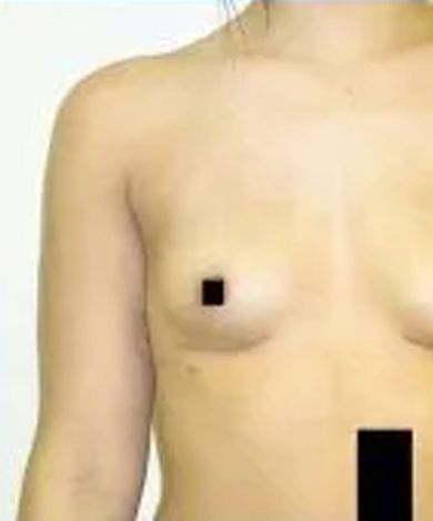 Torso of a person with bare chest and arm; a black square covers one nipple, another obscures the abdomen.