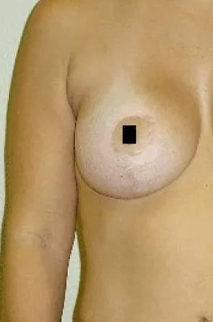 Torso of a person with a bare breast; nipple obscured by a black square.