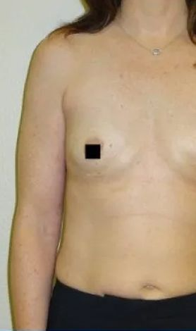 Woman's torso, one arm visible, standing against a beige background; nipples obscured.