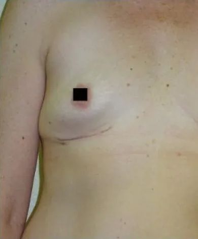 Chest with surgical scar and obscured nipple.
