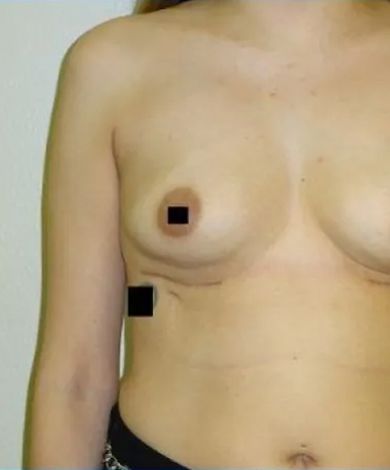Close-up of a person's torso, with a breast visible and the nipple obscured by a black square.