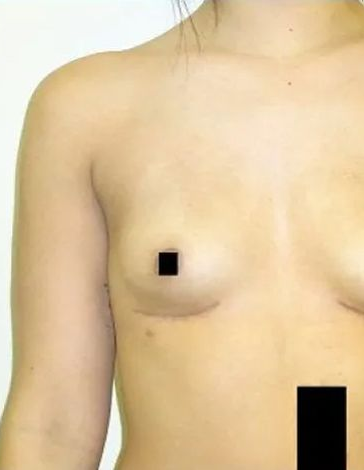 Torso of a person with a surgical scar on their chest. The nipple and lower abdomen are obscured.