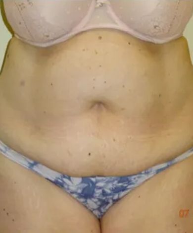 A person's midriff wearing a bra and underwear, showing their abdomen.