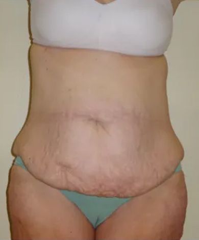Torso after abdominal surgery; loose skin, scar across abdomen, underwear.
