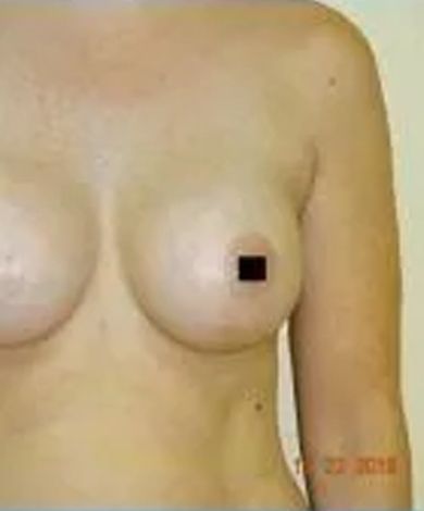 Woman's bare chest; one nipple obscured by a black square. Beige skin, light background.