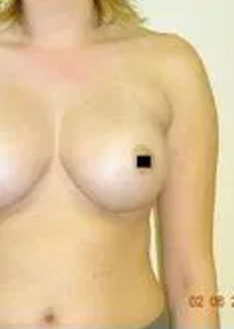 Torso of a person, breasts visible, right nipple obscured, date stamp in the corner.