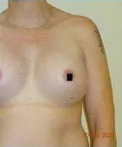 Bare chest with a dark square obscuring one nipple. The skin is light.
