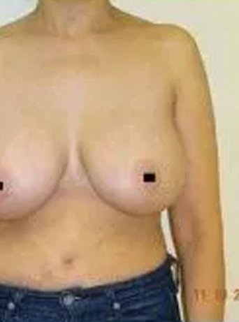 Upper torso of a person in a denim garment. Breasts are visible with nipples covered. Light background.