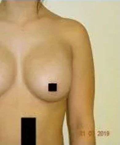 Torso of a person with bare chest, one nipple and lower abdomen obscured by black boxes.