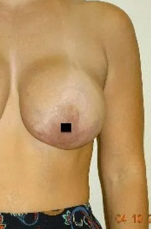 Woman's bare chest with one nipple obscured by a black square. Beige skin, neutral background, date on bottom right.