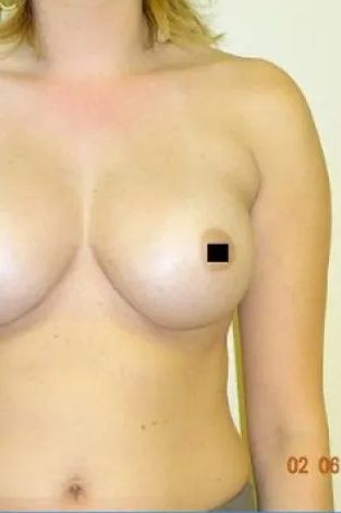 A person's bare chest with one nipple obscured by a black square. The date '02 06 2018' is in the lower right corner.