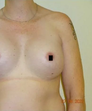 Torso with one nipple obscured by a black square. A scar is visible under the breasts, and a tattoo is on the arm.
