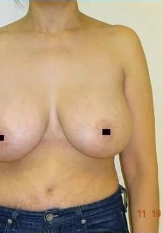 Torso of a person wearing jeans with two breasts, nipples covered, against a plain background.