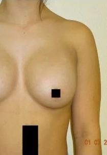 Torso with blacked out sections; skin tone, breast and arm visible; light background.