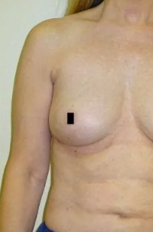 Bare chest with a small black square covering the nipple.