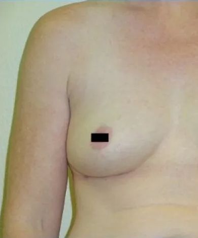 A person's torso, featuring one breast with a blurred nipple, and visible surgical scar.
