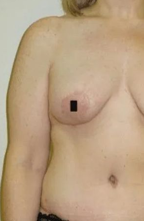 Torso of a person with a black square covering a nipple.