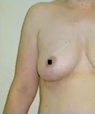 Torso of a person, showing an arm and breast. The nipple is obscured by a black square.