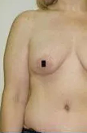 Torso of a person with a black square covering a nipple.