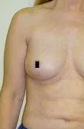 A person's torso and left arm. Left breast is visible with a black square over the nipple.