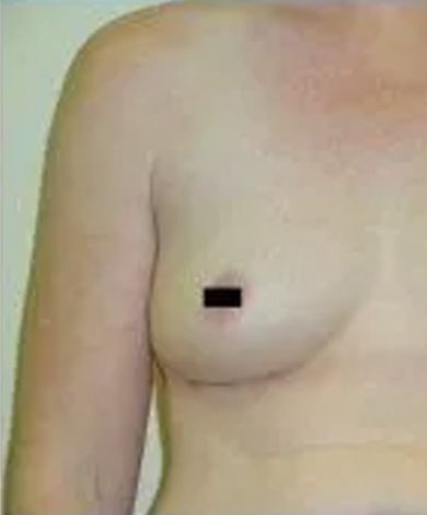 Person's torso with a breast; the nipple is obscured. Skin tone is light.