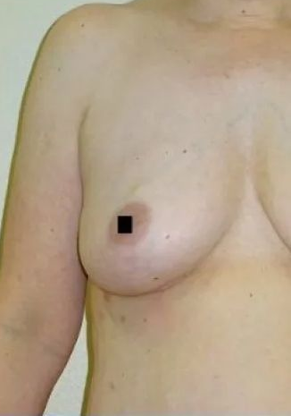 Torso with a breast; nipple is obscured by a black square. Skin is light-toned.