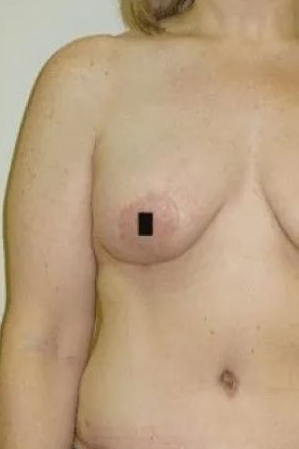 Torso, woman; left breast visible with a dark square covering the nipple.