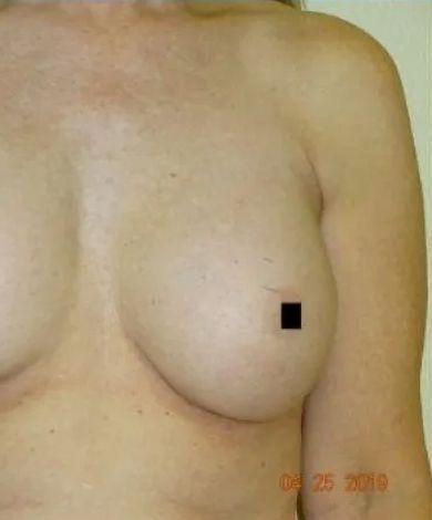 Woman's bare chest; a right breast is centered with a small black square covering the nipple.