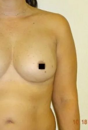 Person's upper body; bare chest and arm; right nipple covered by a black square. Beige background.