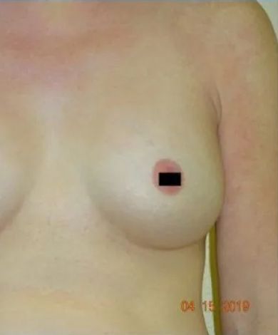 Close-up of a person's chest, right breast visible. Skin is fair, nipple is blocked out.