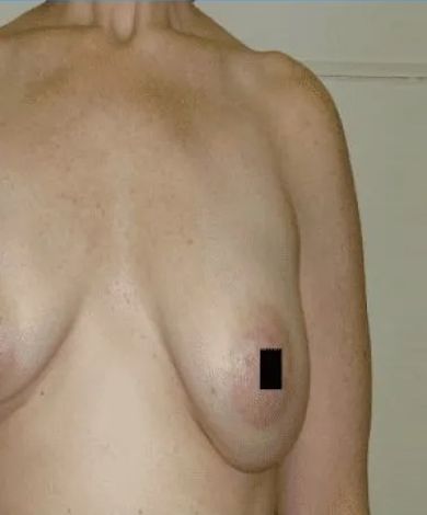 Torso with breasts, light skin. Black square covers the nipple on the right breast.